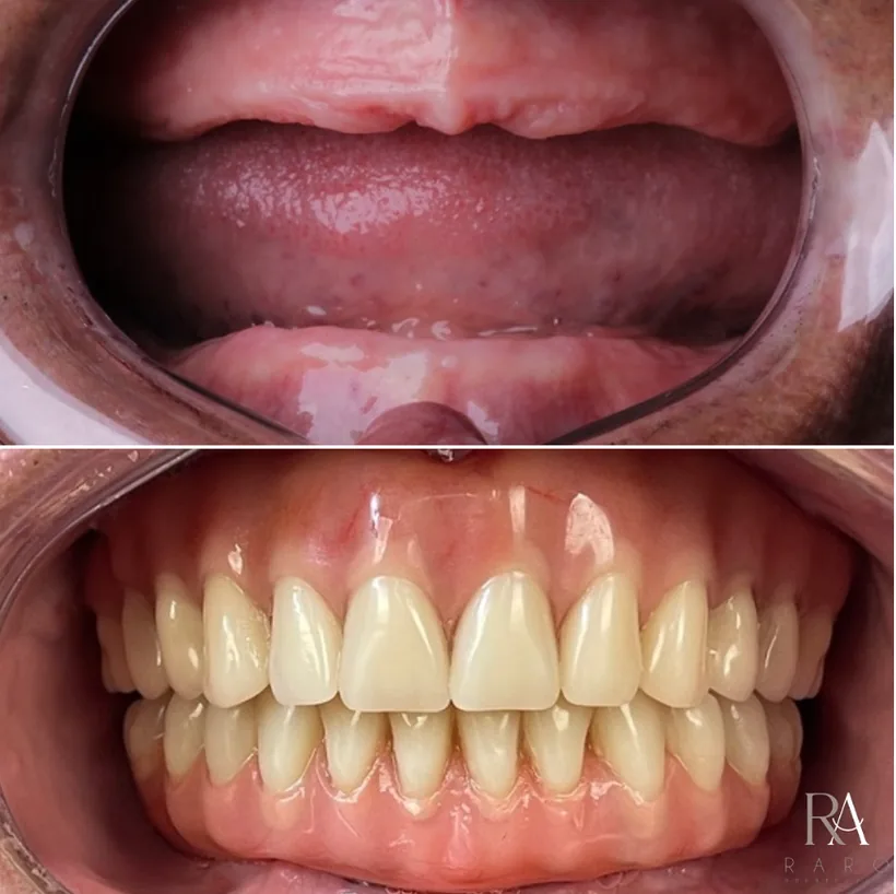 Caso 02: antes e depois de protocolo fixo na Raro Odontologia