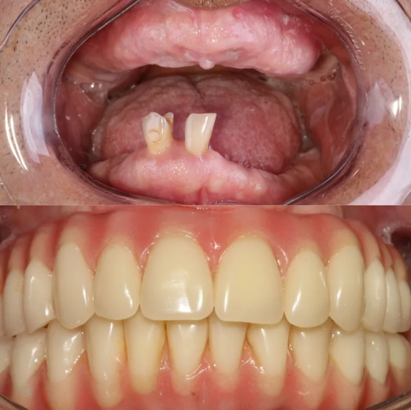 Caso 03: antes e depois de protocolo fixo na Raro Odontologia